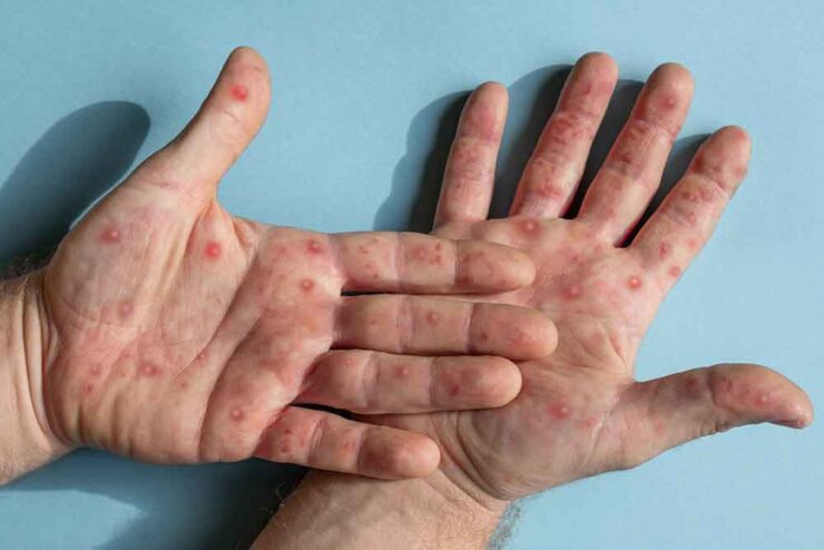 monkeypox virus